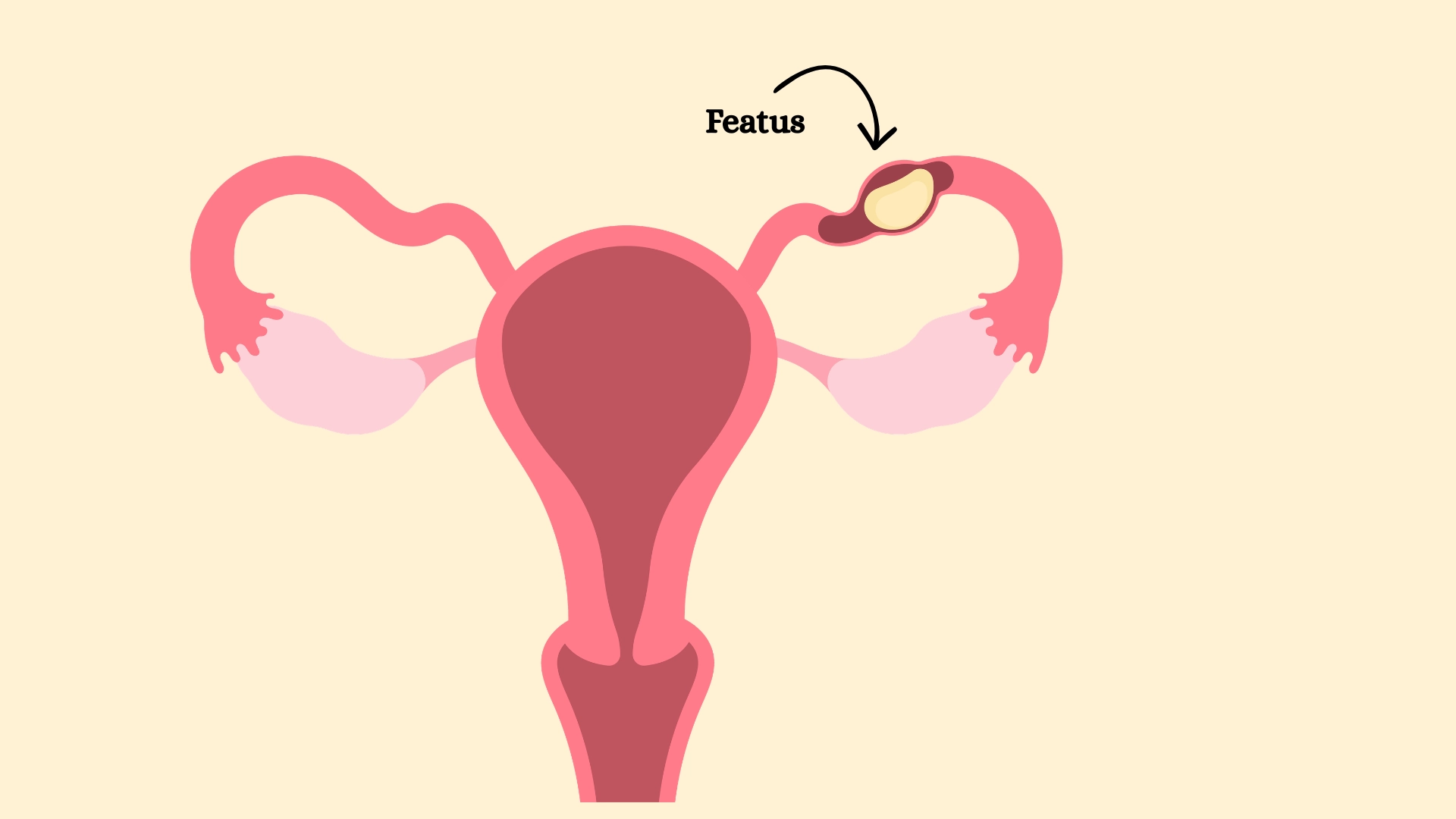 Diagram of the female reproductive system showing an ectopic pregnancy. The fetus is labeled in the fallopian tube, highlighting an abnormal location.