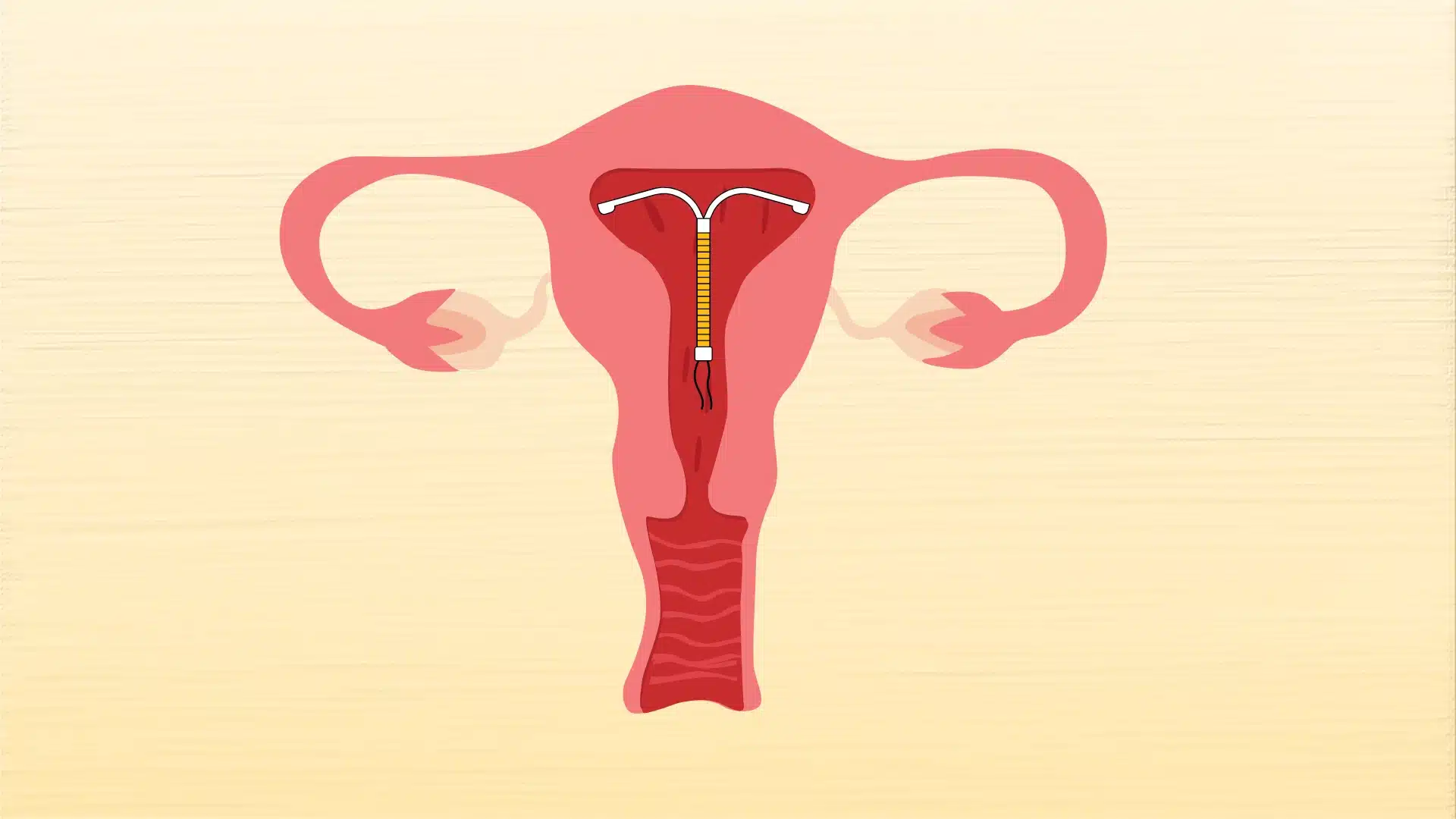 Illustration of a uterus with an intrauterine device (IUD) inserted, showing fallopian tubes on each side.